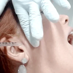 Viscossuplementação Viscossuplementação