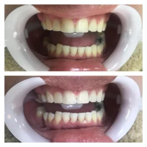 Clareamento Dental Clareamento Dental