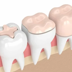 Coroas dentaisonlays Coroas dentaisonlays