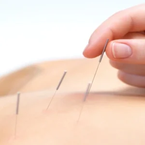 Dry Needling Dry Needling