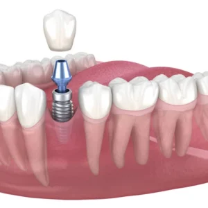 Implantes Dentários Implantes Dentários